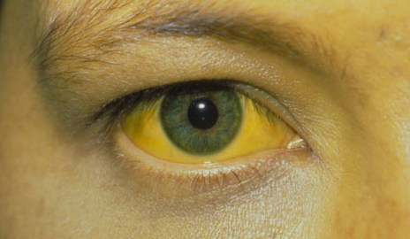 Hepatitis symptoms Hepatitis symptoms