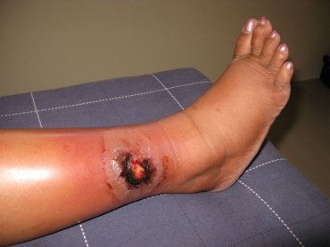 Dangerous wound Dangerous wound